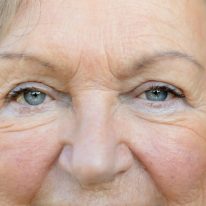 Laser SLT (Selektywna Trabekuloplastyka Laserowa), na czym polega?