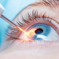 Irydotomia laserowa – zabieg w leczeniu jaskry