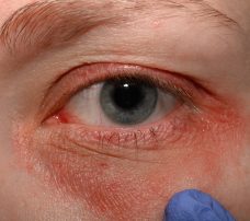 Zapalenie brzegów powiek (blepharitis) – jak sobie radzić z przewlekłym problemem?