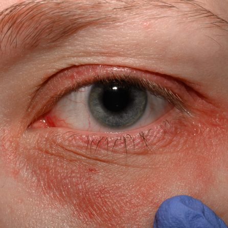 Zapalenie brzegów powiek (blepharitis) – jak sobie radzić z przewlekłym problemem?